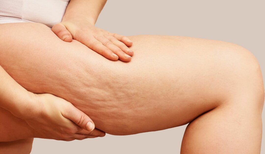 Come eliminare la cellulite: rimedi e trattamenti efficaci