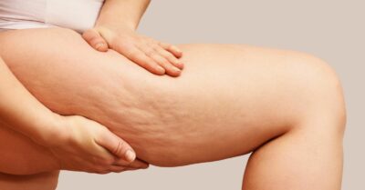 Come eliminare la cellulite: rimedi e trattamenti efficaci